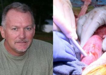Successfully Pig Kidney Transplant on Brain Dead Patient