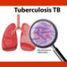tb