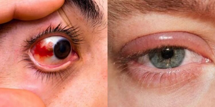 eye conjunctivitis in mumbai