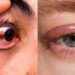 eye conjunctivitis in mumbai