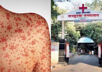 Measles outbreak in Mumbai, Kasturba Hospital ready to fight