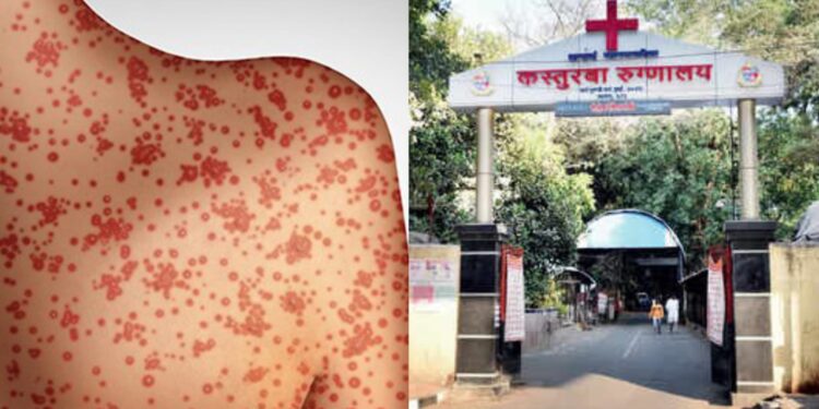Measles outbreak in Mumbai, Kasturba Hospital ready to fight