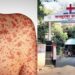 Measles outbreak in Mumbai, Kasturba Hospital ready to fight