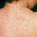 measles