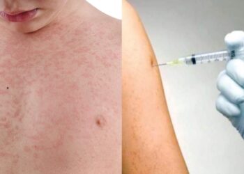 measles-outbreak-in-mumbai