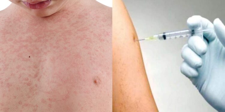 measles-outbreak-in-mumbai